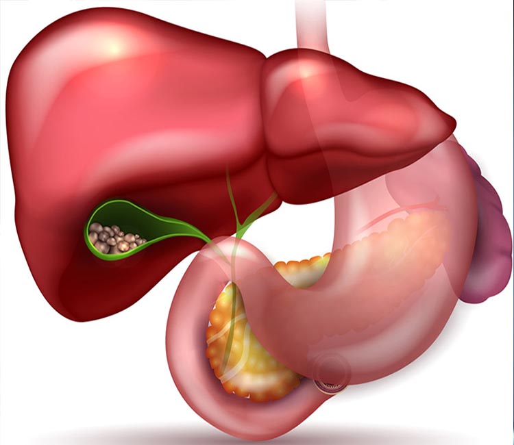 Inguinal Hernia Image